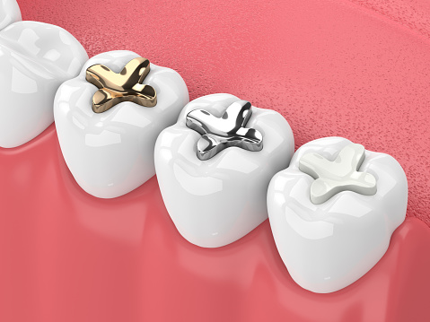 Tooth Fillings sebastopol